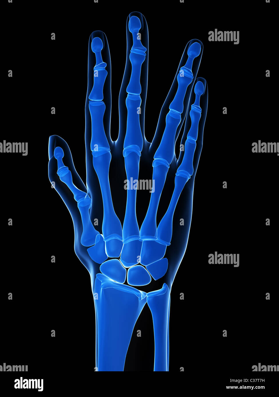 Röntgen-Hände - arthritis Stockfoto