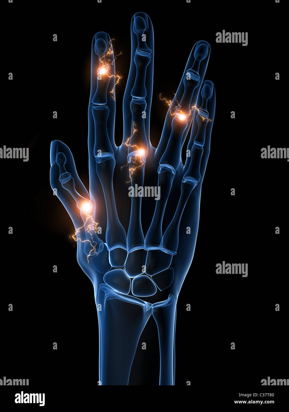 menschliche Hand - arthritis Stockfoto