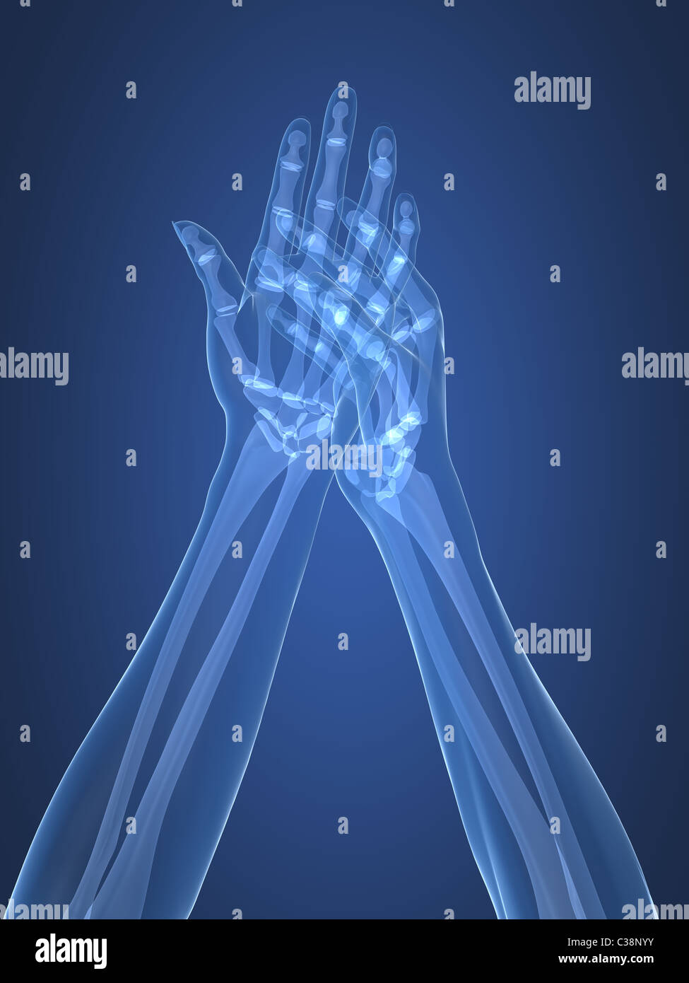 Röntgen-Hände - arthritis Stockfoto
