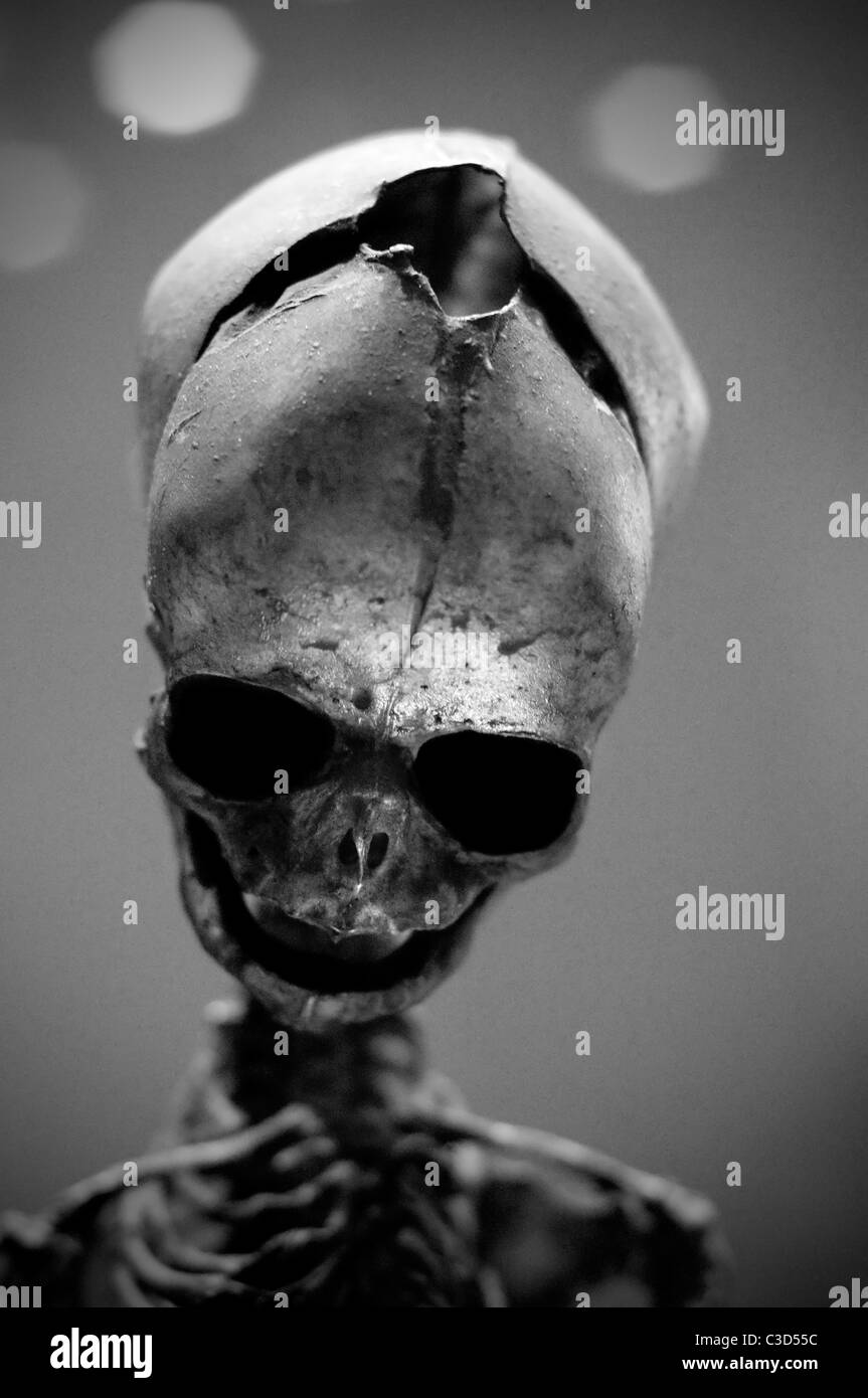 Deformierter Schädel mit einem Loch im Kopf Stockfoto