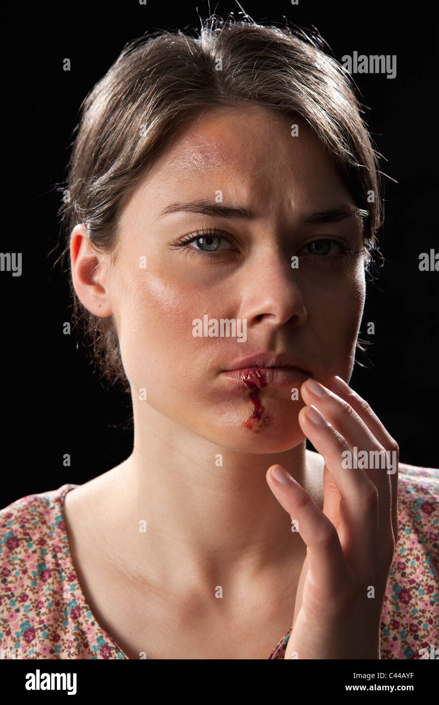Eine Frau mit blauen Flecken und blutigen Lippe Stockfoto