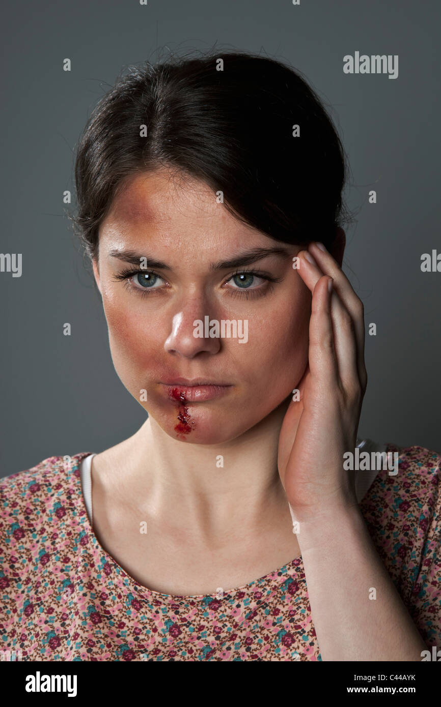 Eine Frau mit blauen Flecken und blutigen Lippe Stockfoto