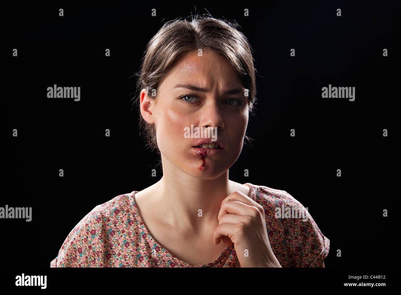 Eine Frau mit blauen Flecken und blutigen Lippe Stockfoto