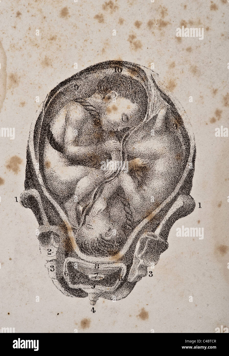 Abbildung von zwei menschlichen Fötus vor der Geburt ca. 1844 Stockfoto