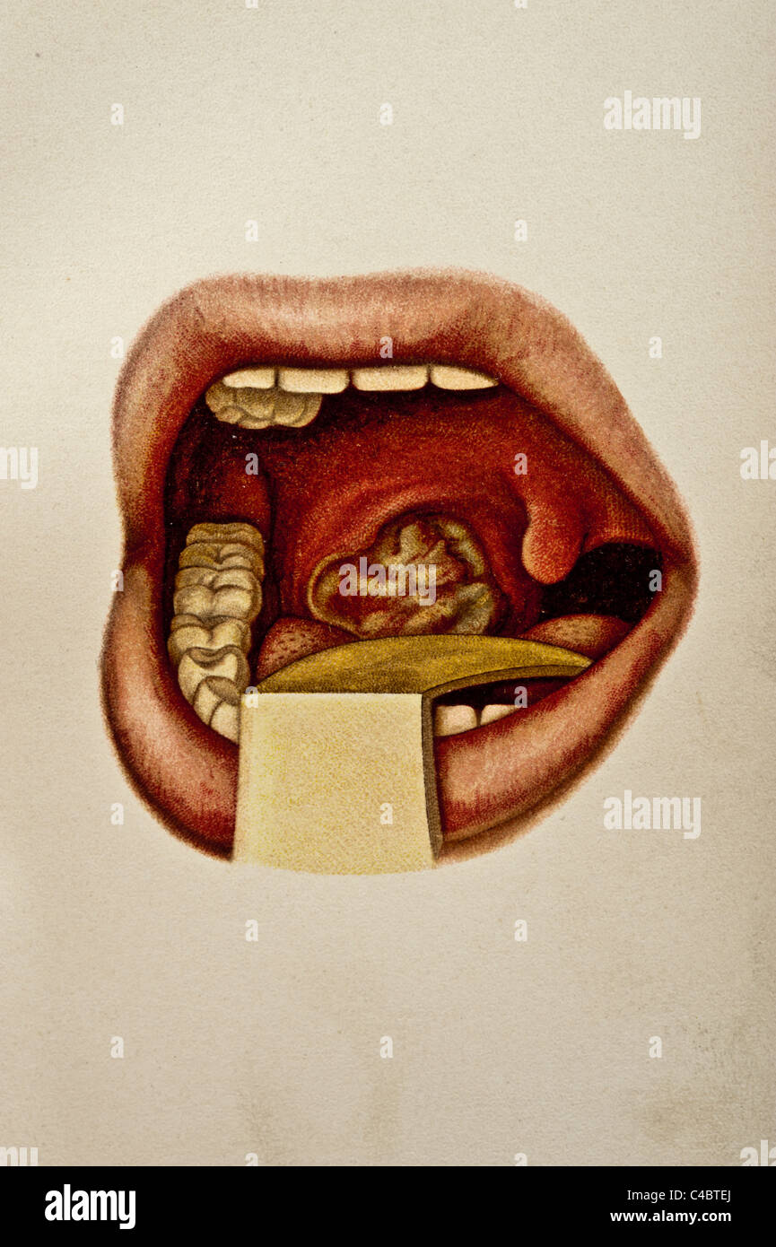 Abbildung der Sklerose der menschlichen Tonsillen copyright 1898 Stockfoto