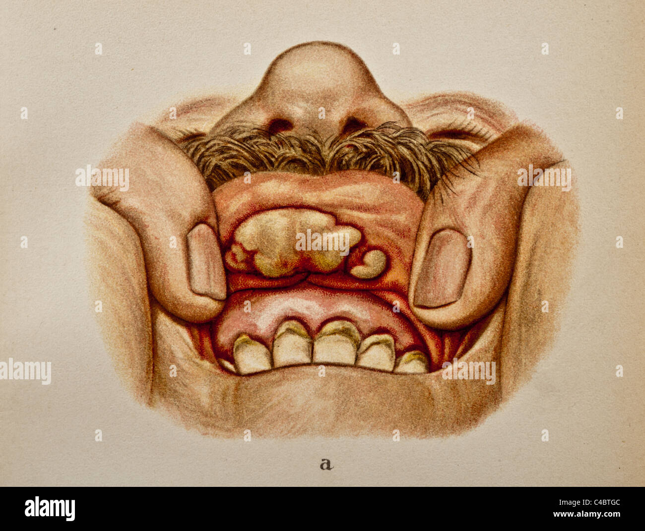 Abbildung einer Nekrose der Schleimhaut des menschlichen Lippe copyright 1898 Stockfoto