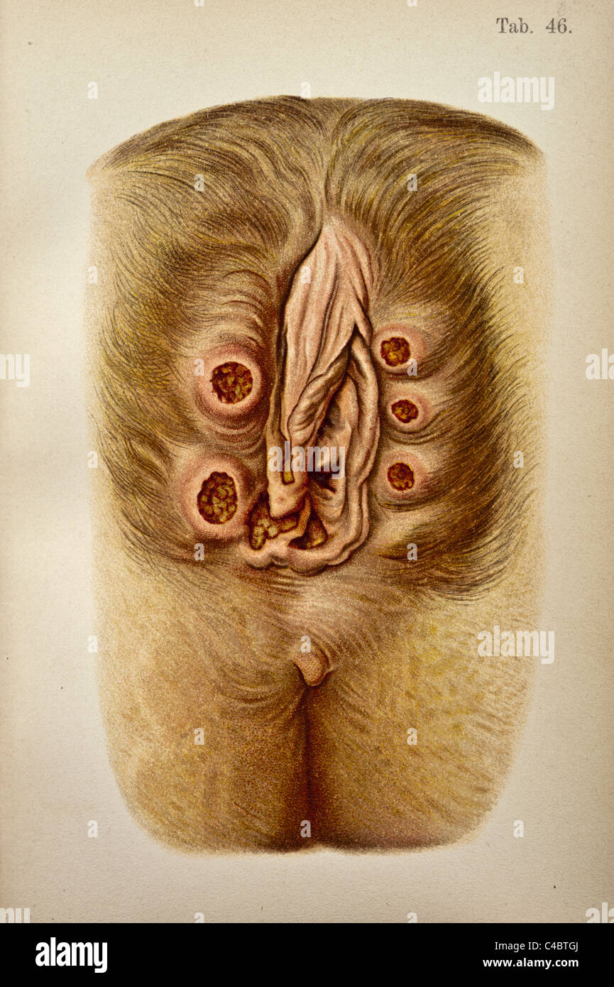 Abbildung von venerischen Geschwüren auf der menschlichen Vagina copyright 1898 Stockfotografie Foto