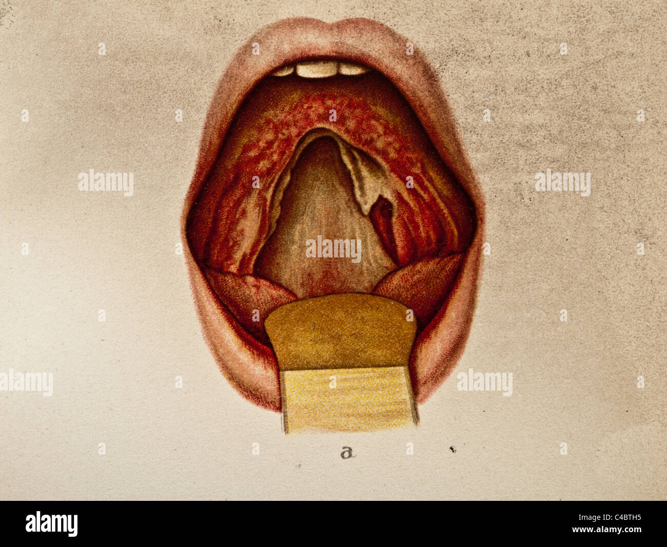 Abbildung der Zerstörung der menschlichen Gaumensegel copyright 1898 Stockfoto
