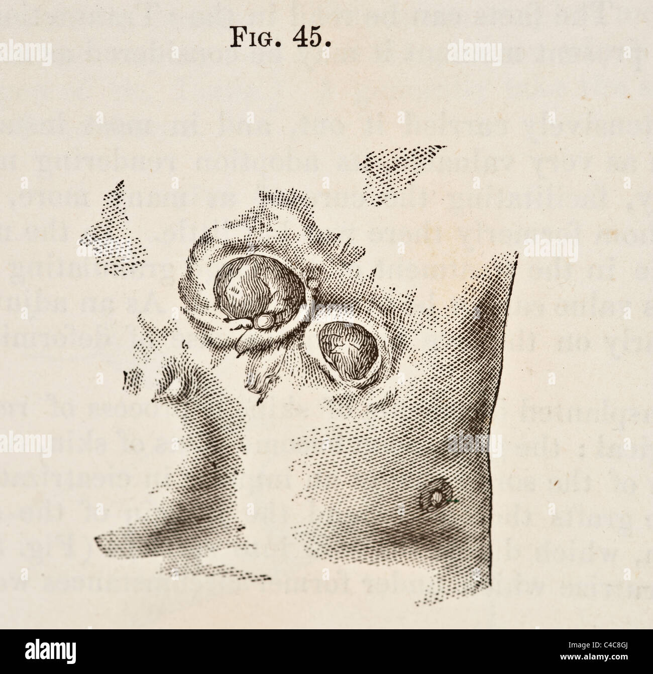Antike medizinische Illustration der Narben (Narbenkeloid) ca. 1881 Stockfoto