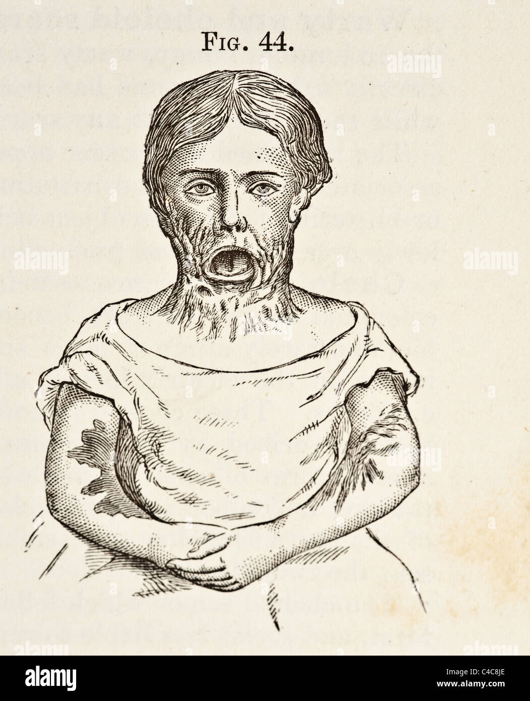 Antike medizinische Illustration der Hals brennen und wohlgenährt ca. 1881 Stockfoto