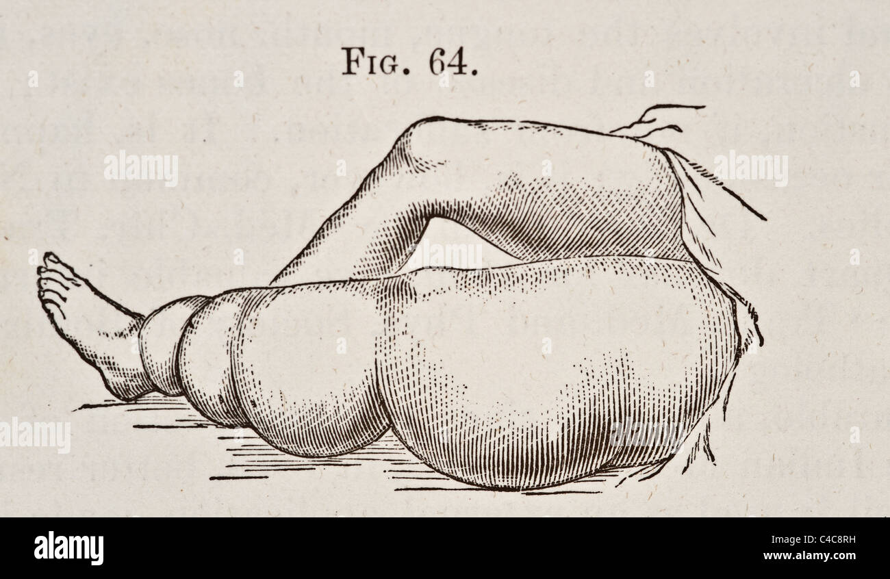 Antike medizinische Illustration der Elephantiasis ca. 1881 Stockfoto
