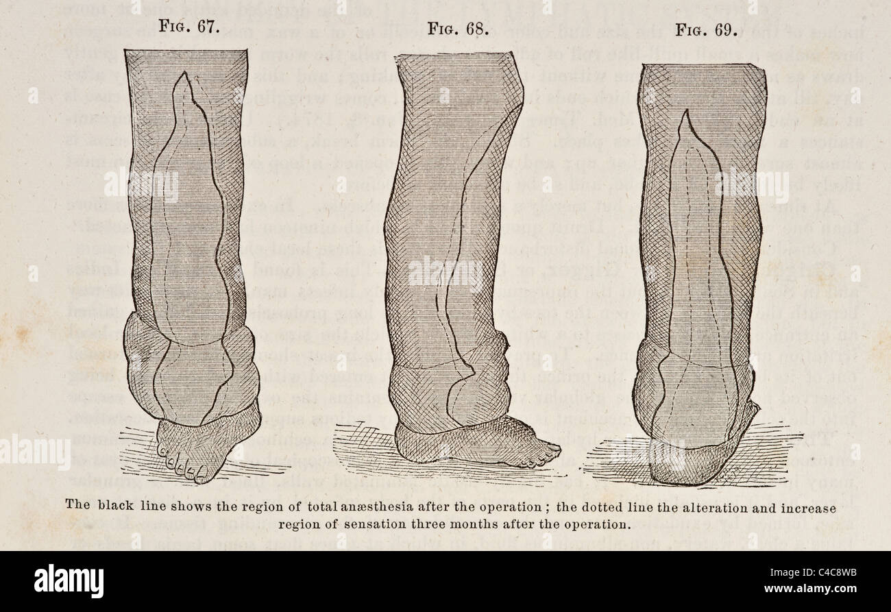 Antike medizinische Illustration der Elephantiasis ca. 1881 Stockfoto