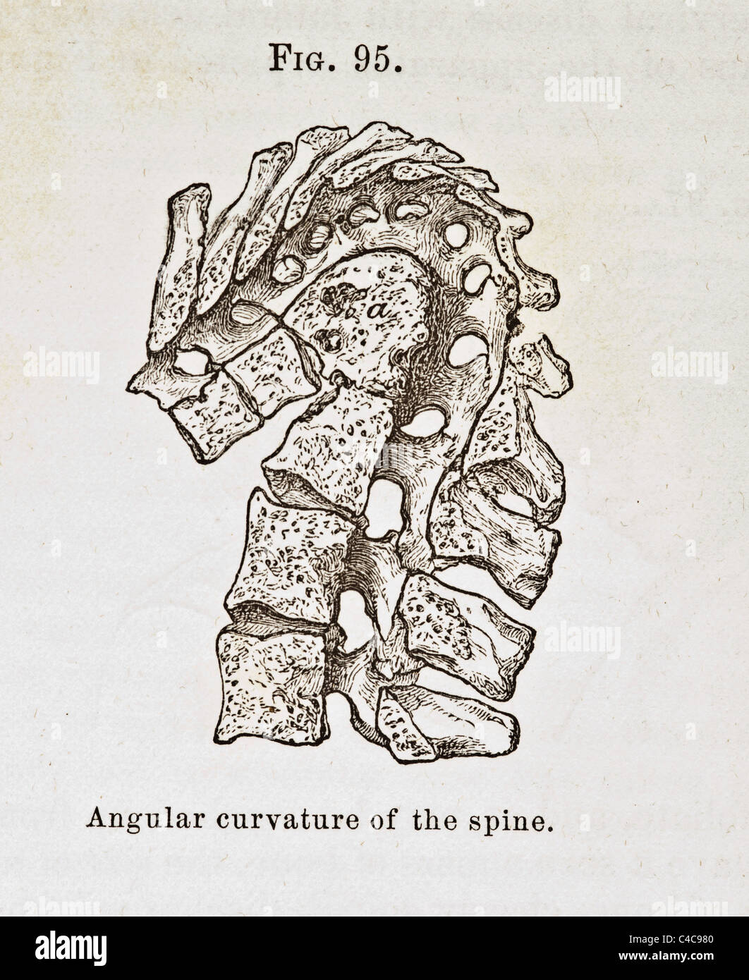 Antike Medizinische Illustration Darstellung Der Krummung Der Wirbelsaule Stockfotografie Alamy