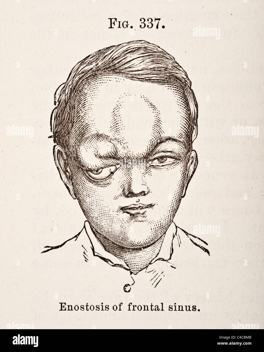 Antike medizinische Illustration, Darstellung der Krankheit der Stirnhöhle ca. 1881 Stockfoto