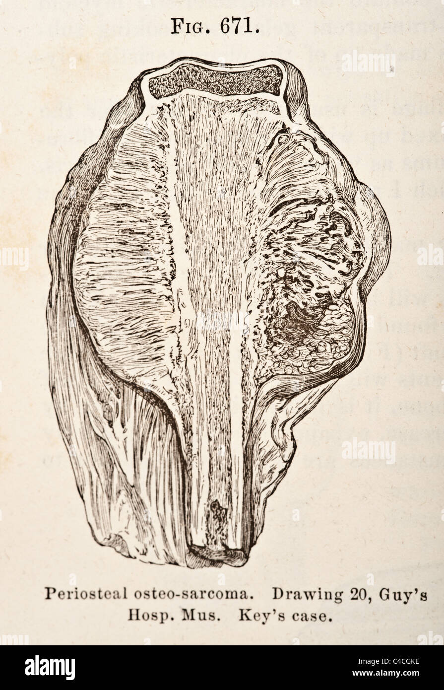 Antike medizinische Illustration von Tumoren der Knochen ca. 1881 Stockfoto