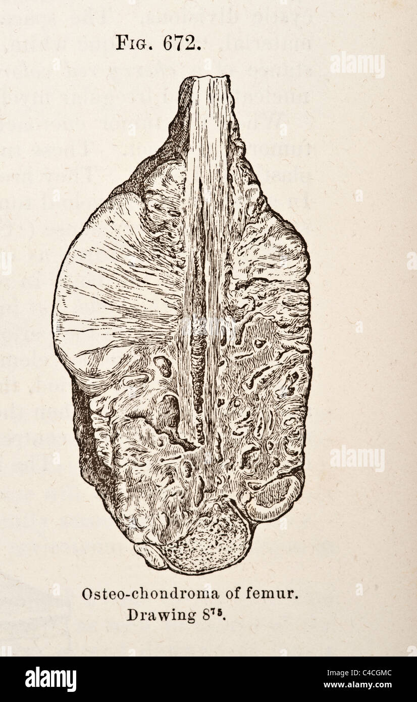 Antike medizinische Illustration von Tumoren der Knochen ca. 1881 Stockfoto