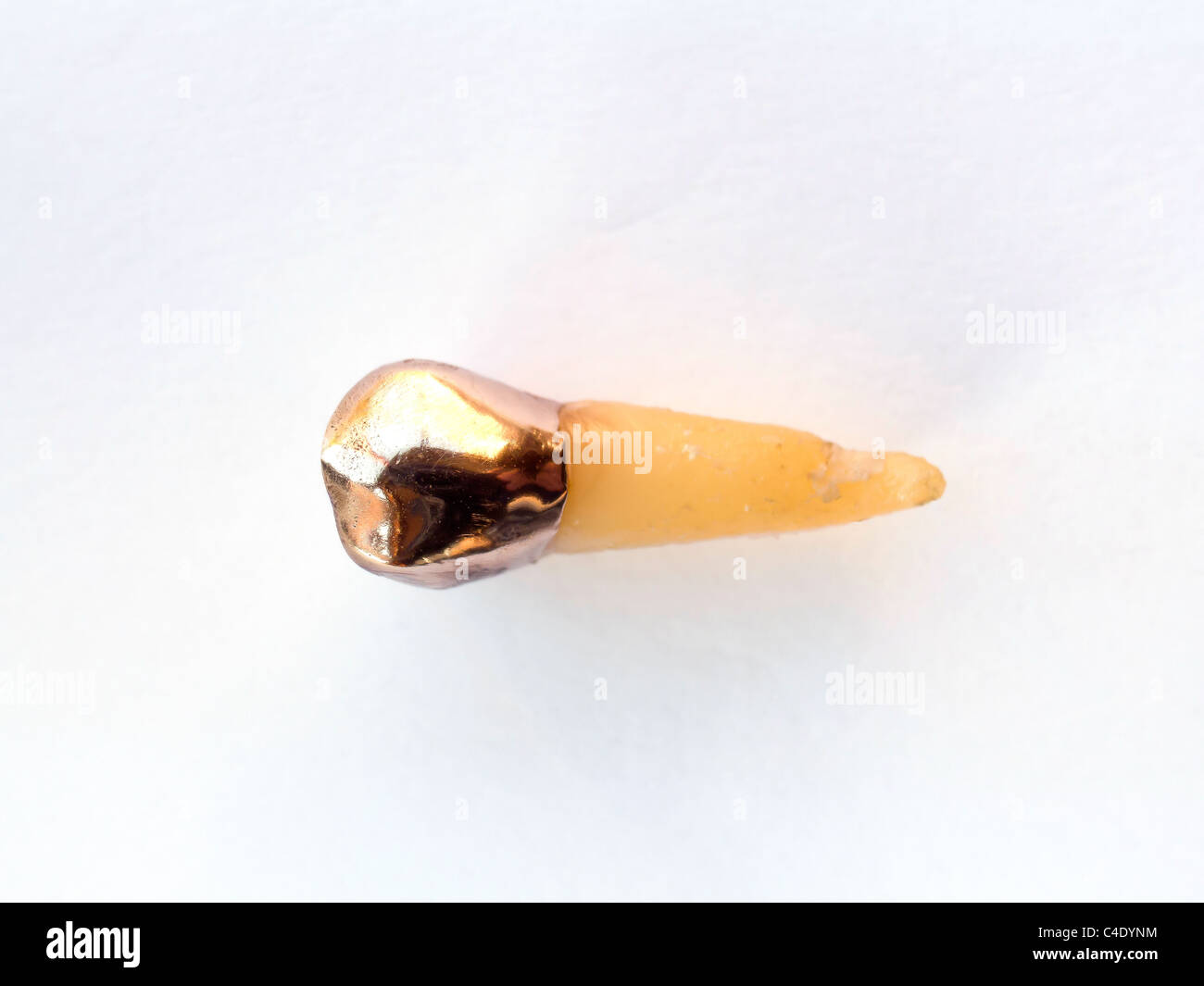 Ein extrahierter Prämolaren Zahn, mit einer goldenen Krone ausgestattet hatte, anschließend repariert und dann extrahiert Stockfoto