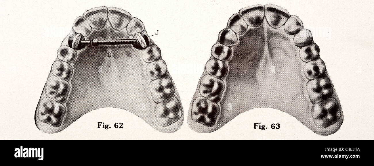 Illustration des menschlichen Zähnen copyright 1911 Stockfoto