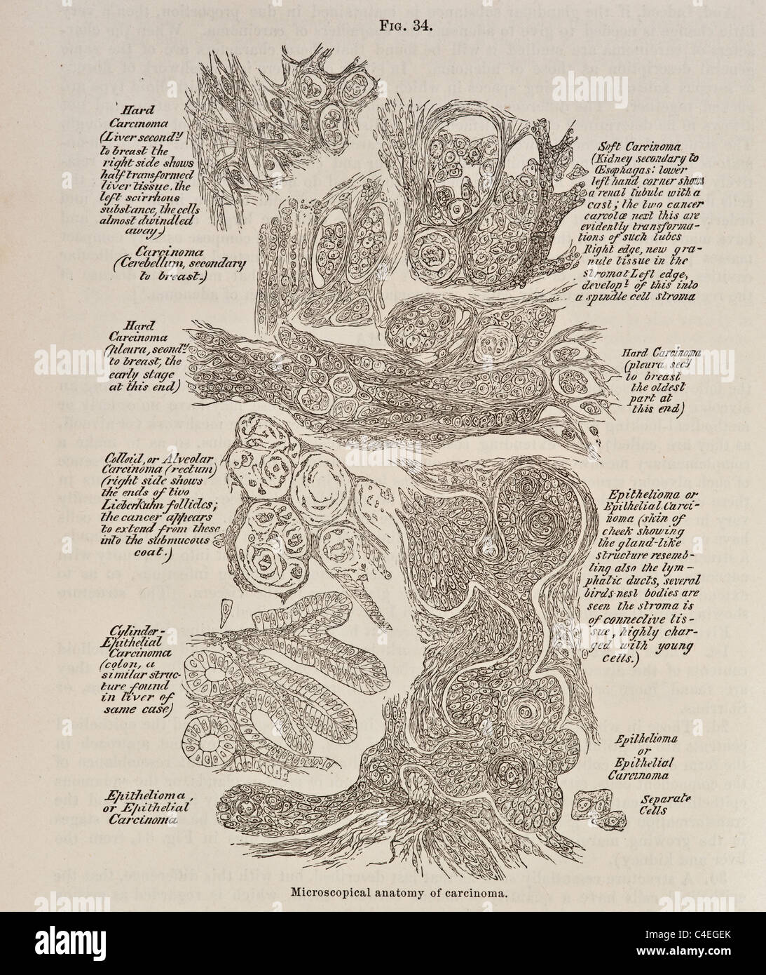 Antike Darstellung der mikroskopischen Anatomie des Karzinoms ca. 1881 Stockfoto