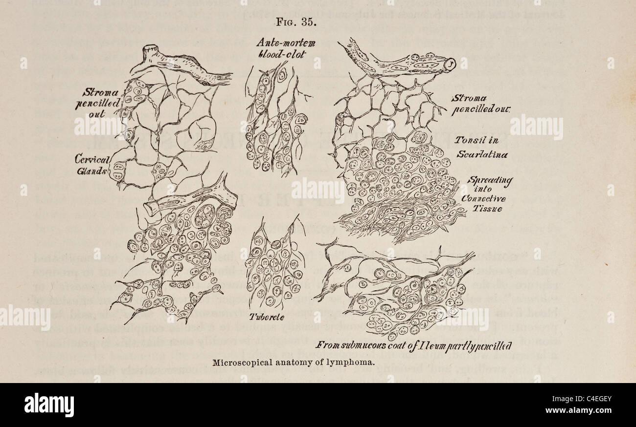 Antike Darstellung der mikroskopischen Anatomie des Lymphoms ca. 1881 Stockfoto