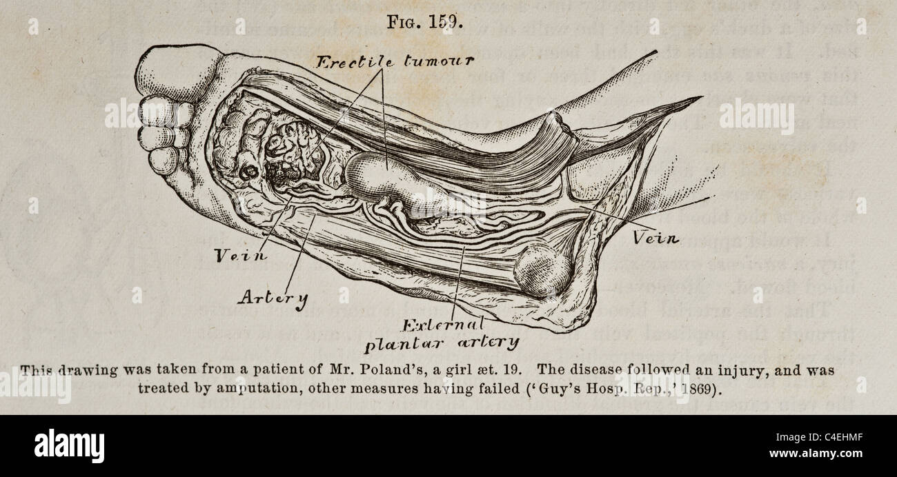 Antike medizinische Illustration des Fußes mit Tumoren ca. 1881 Stockfoto