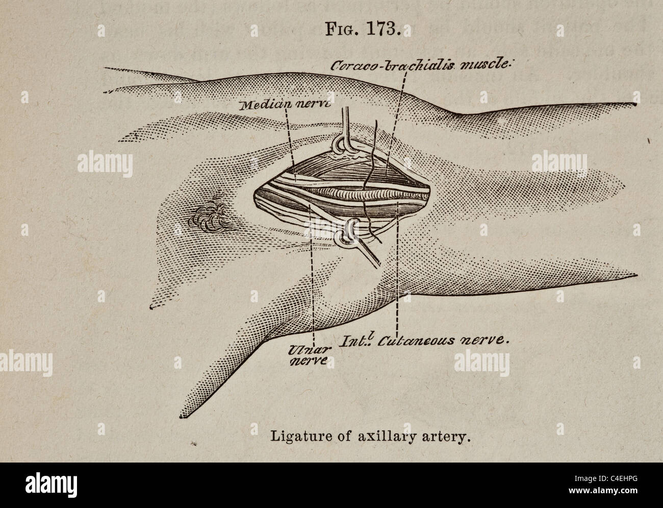 Medizinische Illustration der Ligatur antik, wenn axilläre Arterie ca. 1881 Stockfoto