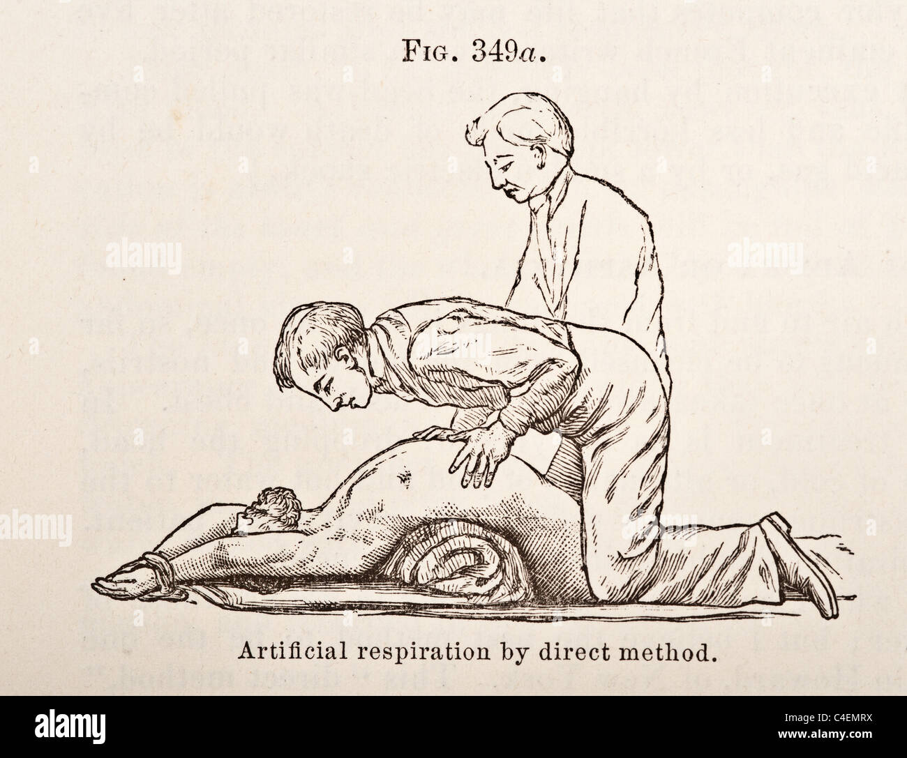 Antike medizinische Illustration der künstlichen Beatmung ca. 1881 Stockfoto