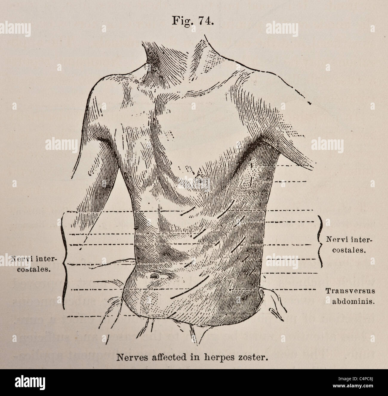 Illustration des Nerven betroffen in Herpes Zoster ca. 1881 Stockfoto