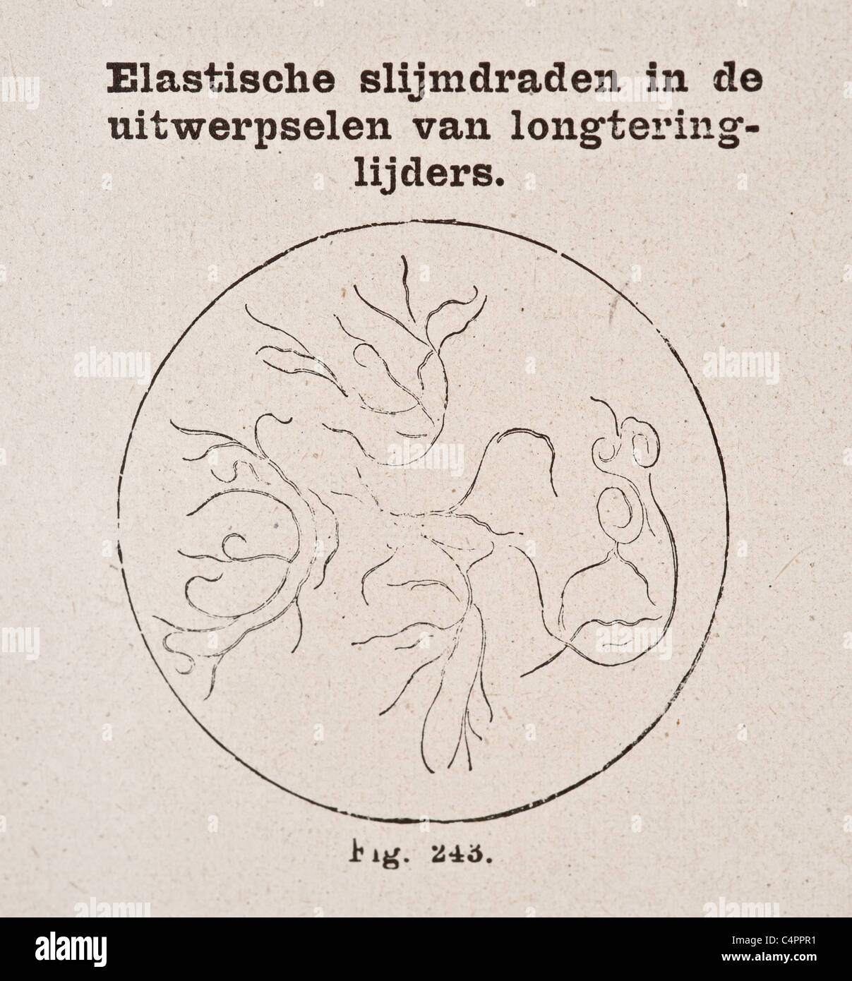 Antike Vintage medizinische Illustration der elastischen Kot Zelle der Tuberkulose leidende ca. 1800 s Stockfoto