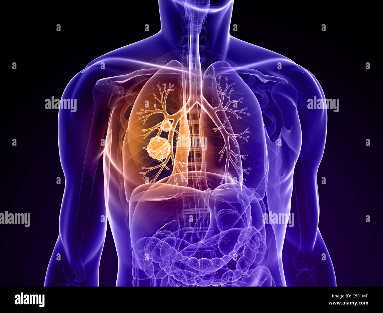 Lungenkrebs Stockfoto