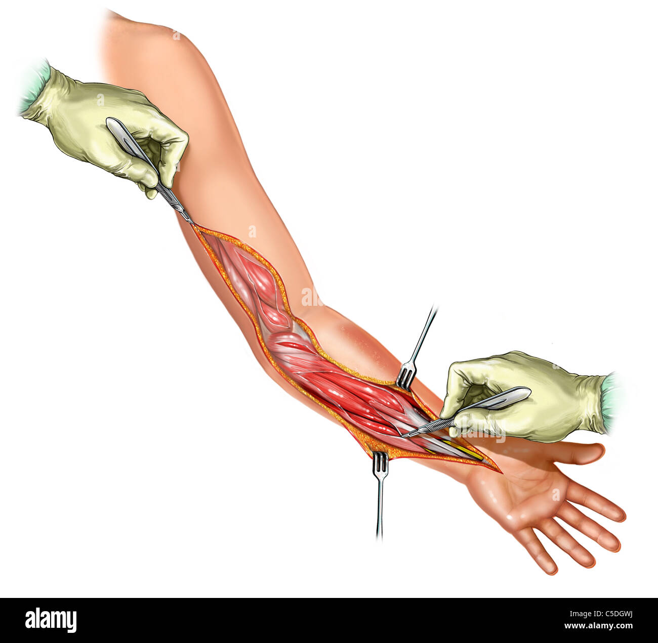 Fasciotomy Instrument Extremity Fasciotomies , Lower extremity fasciotomies – PPLI