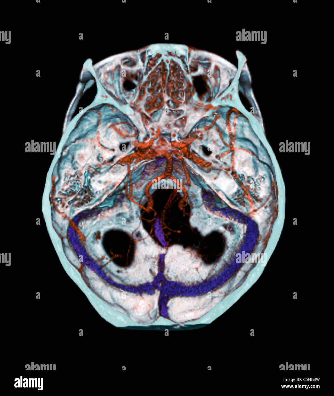Arterien des Gehirns, 3D CT scan Stockfoto