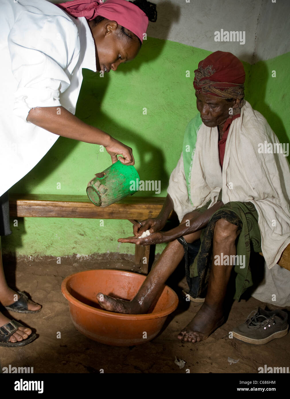 Patienten mit Podoconiosis haben ihre Füße und Beine gemessen in