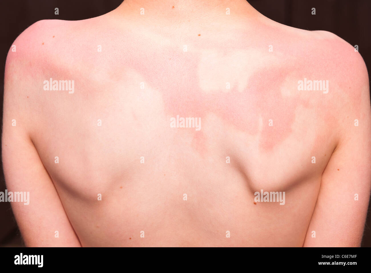 Ein elfjähriger Junge zeigt den sonnenverbrannten Rücken mit den Patches wo die Sonnencreme war n ' t genug gleichmäßig Stockfoto
