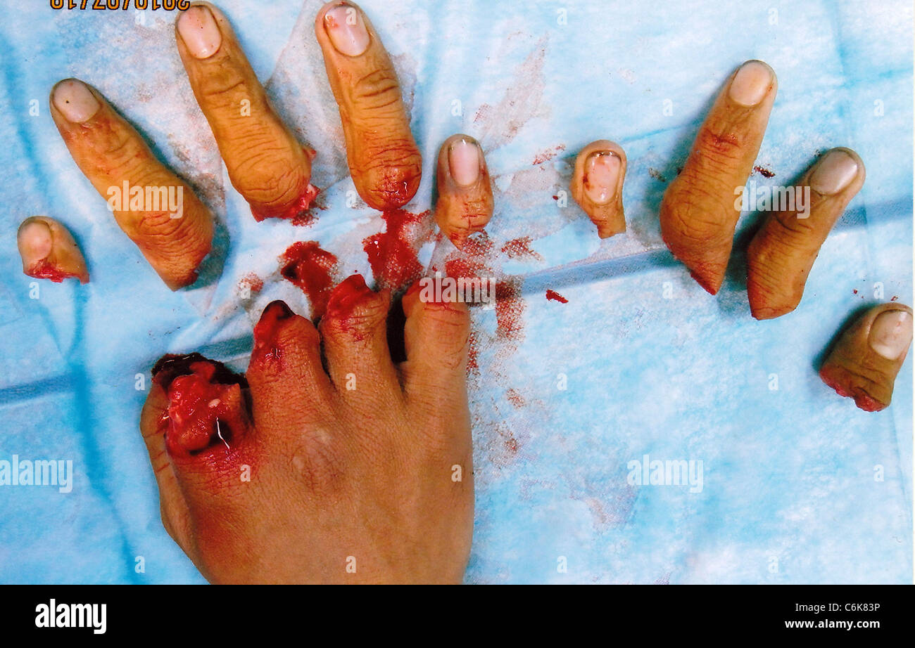 Der Fabrikarbeiter Finger geborgen in Horror schneiden Unfall dieser Fabrikarbeiter aus China hat das Glück, die Funktion behalten Stockfoto