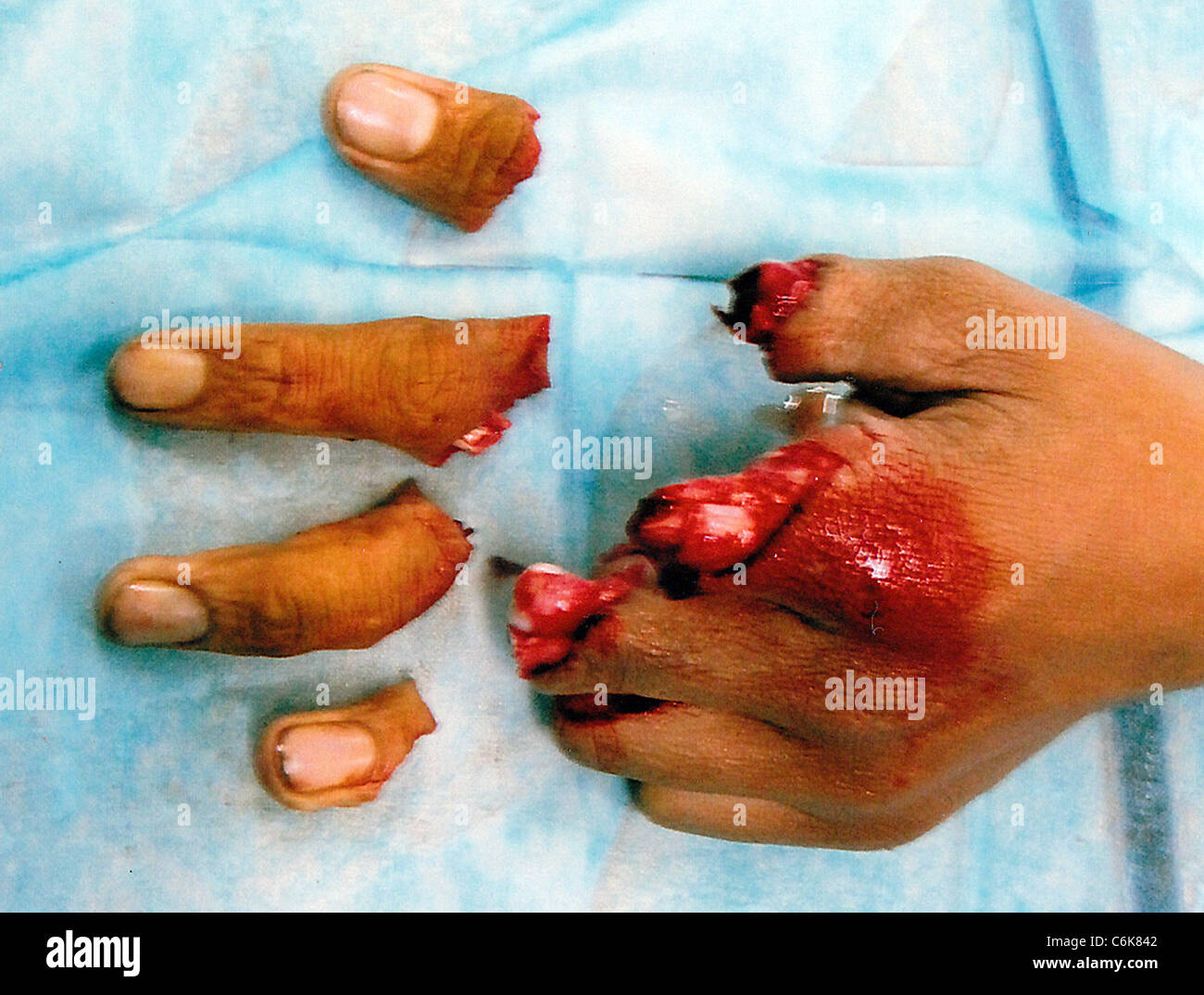 Der Fabrikarbeiter Finger geborgen in Horror schneiden Unfall dieser Fabrikarbeiter aus China hat das Glück, die Funktion behalten Stockfoto