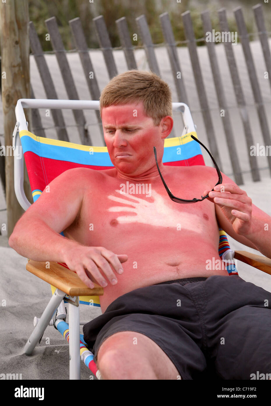 sunburned tourist