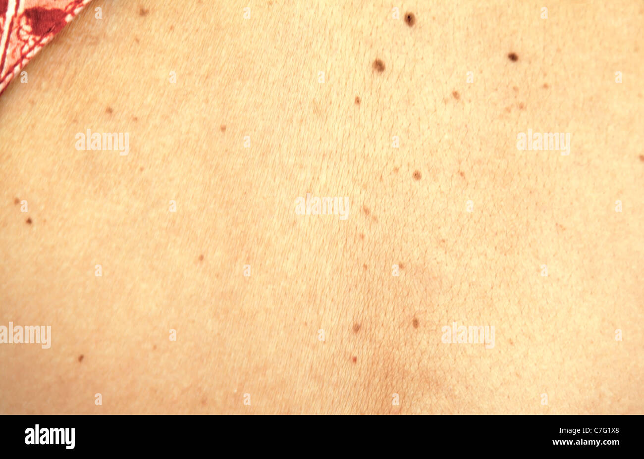 Landschaft, Porträt von asiatischen Womans indischen zurück Hautton mit tiefen und Maulwürfe, Textur, Hintergrund, Textfreiraum und Kopierbereich Stockfoto