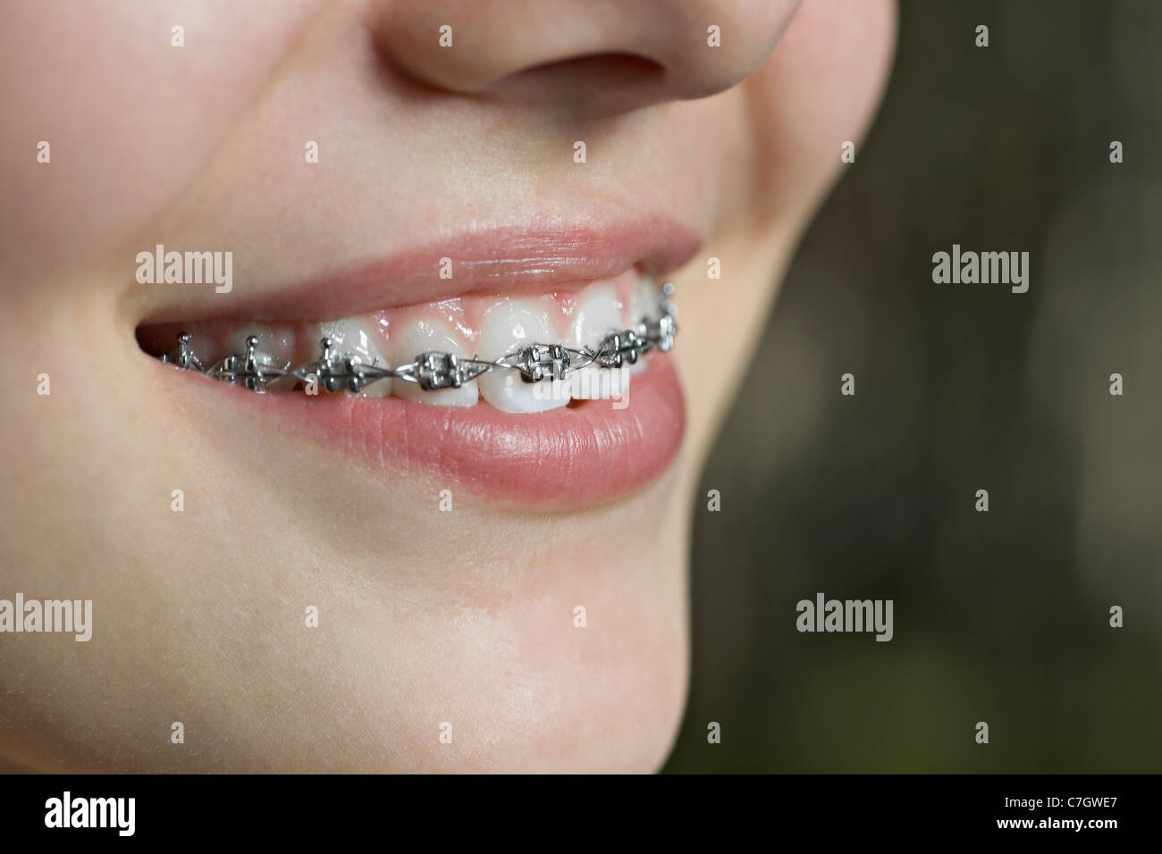 Ein Lächeln auf den Lippen Teenager mit Zahnspangen, ECU Stockfoto