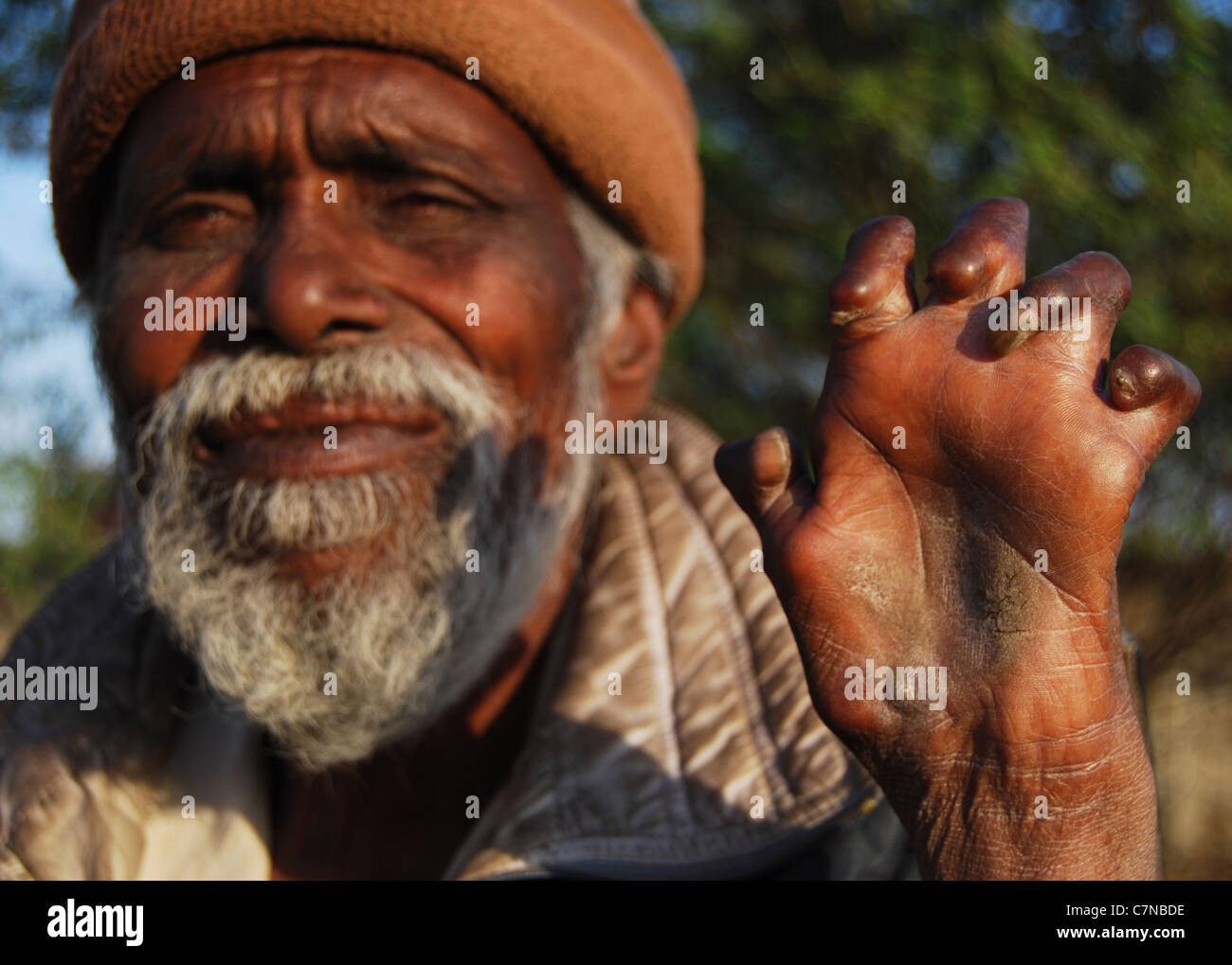 Ein Bettler, Aussätzigen leiden zeigt seine Hand (Indien) Stockfoto