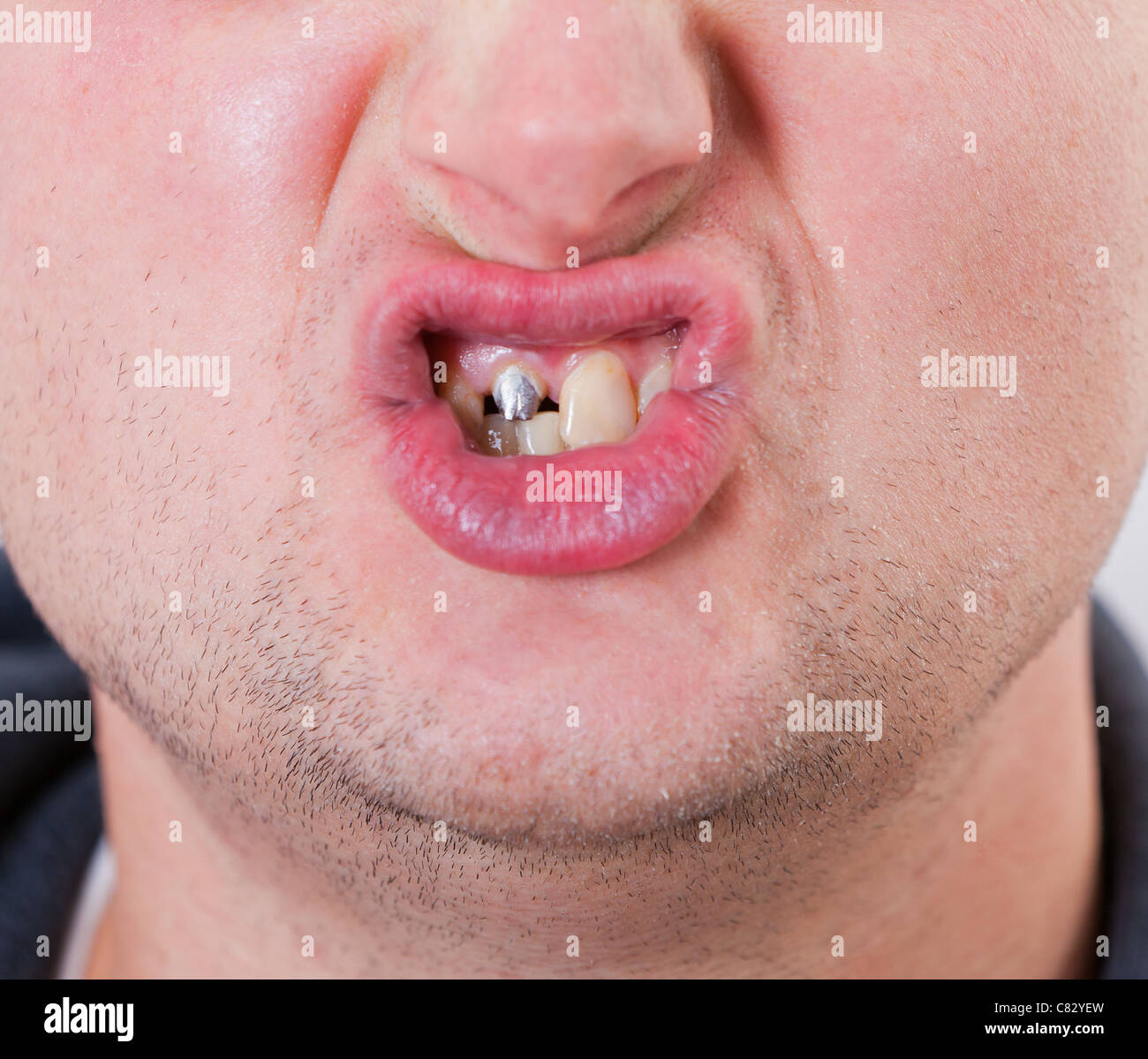 Junger Mann Gesicht mit Zahn-Stift im Mund Stockfotografie - Alamy