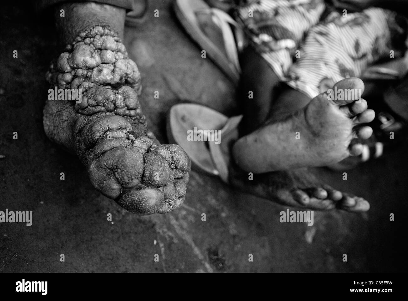 Ein Mann mit einer chronisch entzündlichen Podokoniose in seinen Füßen. Nord-Kivu, DR Kongo Afrika Stockfoto