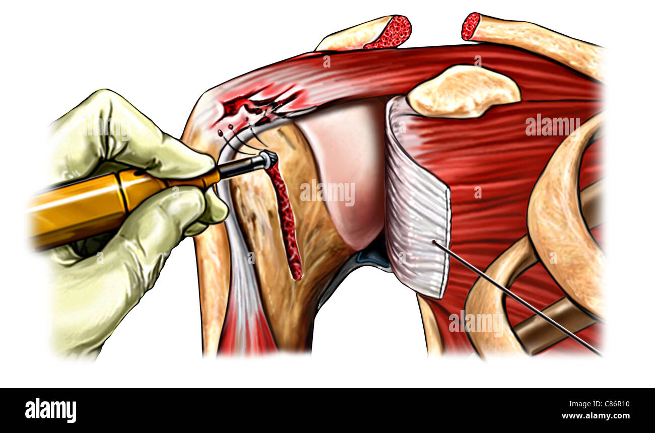 Rotator Cuff Fotos Und Bildmaterial In Hoher Aufl sung Alamy