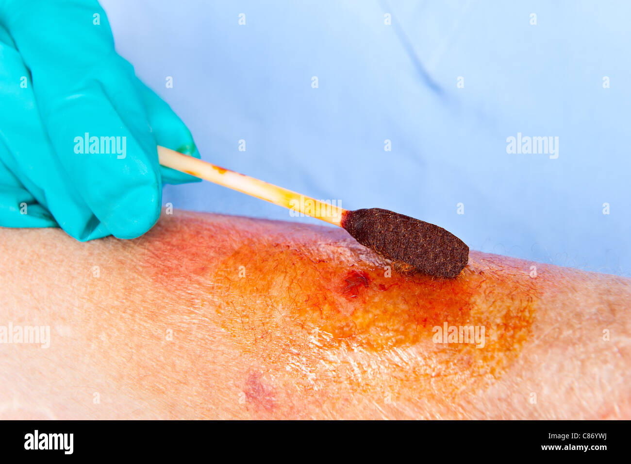 Ein Arzt reinigt eine Wunde mit einer Jod-Tupfer Stockfoto