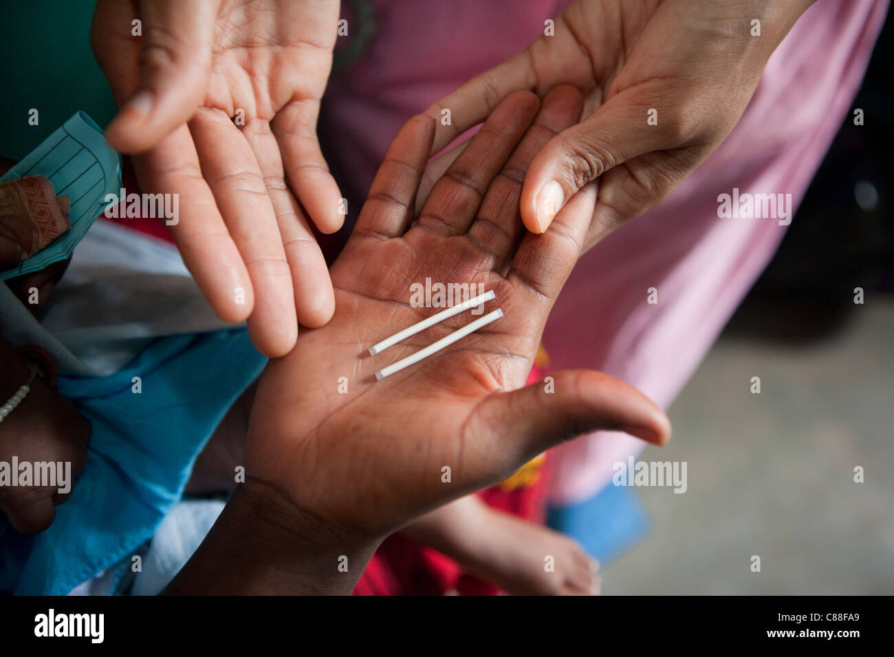 Hormonelle Implantat in den Arm implantiert sind eine Form der Geburtenkontrolle langfristig - Bamako, Mali. Stockfoto