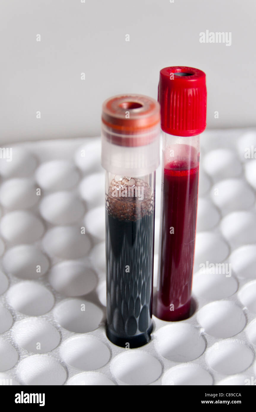 In der Nähe, Glas zwei, reine und gemischte Blut extrahiert für Tests, stehend auf einem weißen Styropor-Tablett voller medizinische Schläuche Stockfoto
