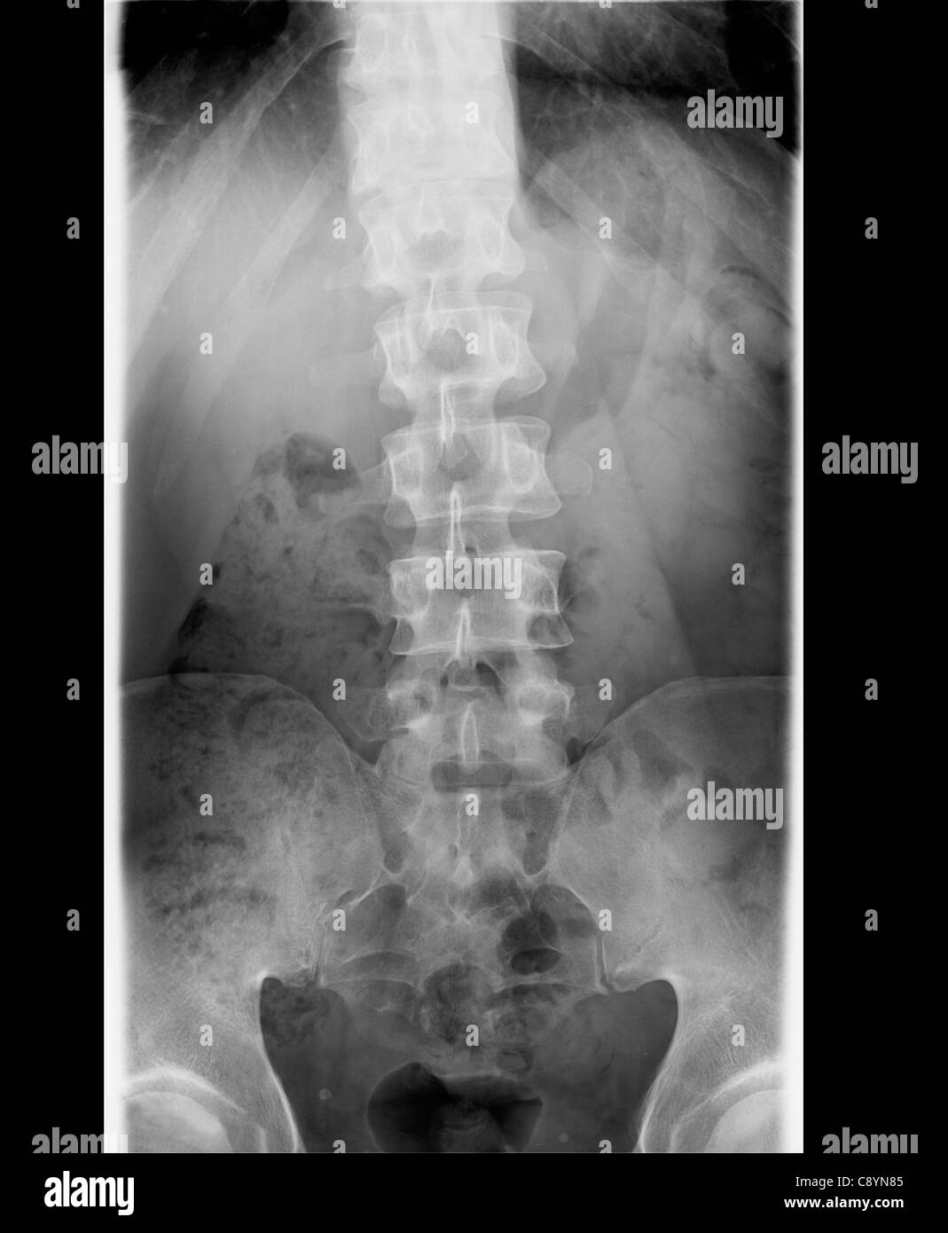 Röntgen der Lendenwirbelsäule, die Kurven in das Kreuzbein. Stockfoto