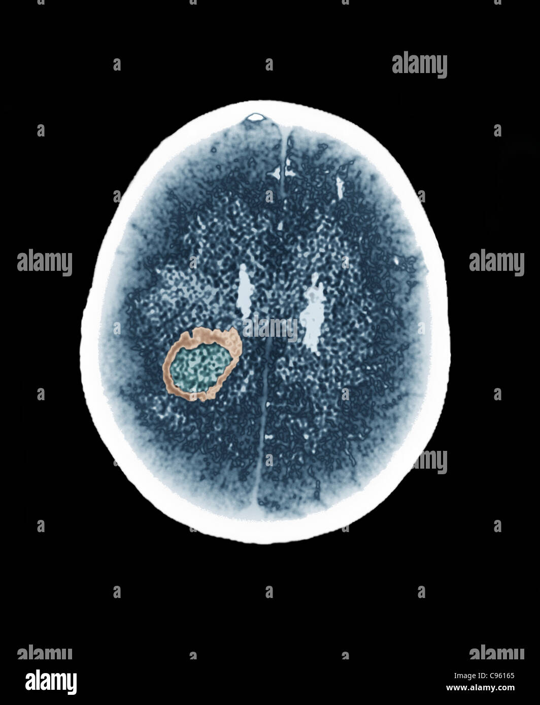 Gehirn Abszess, CT-scan Stockfoto