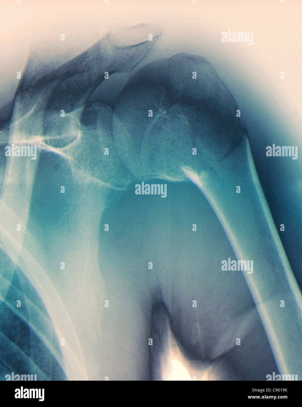 Gebrochene Schulter. Farbig x-ray die Schulter eines Patienten mit einer Fraktur in den Hals des Humerus (Oberarm Knochen). Stockfoto