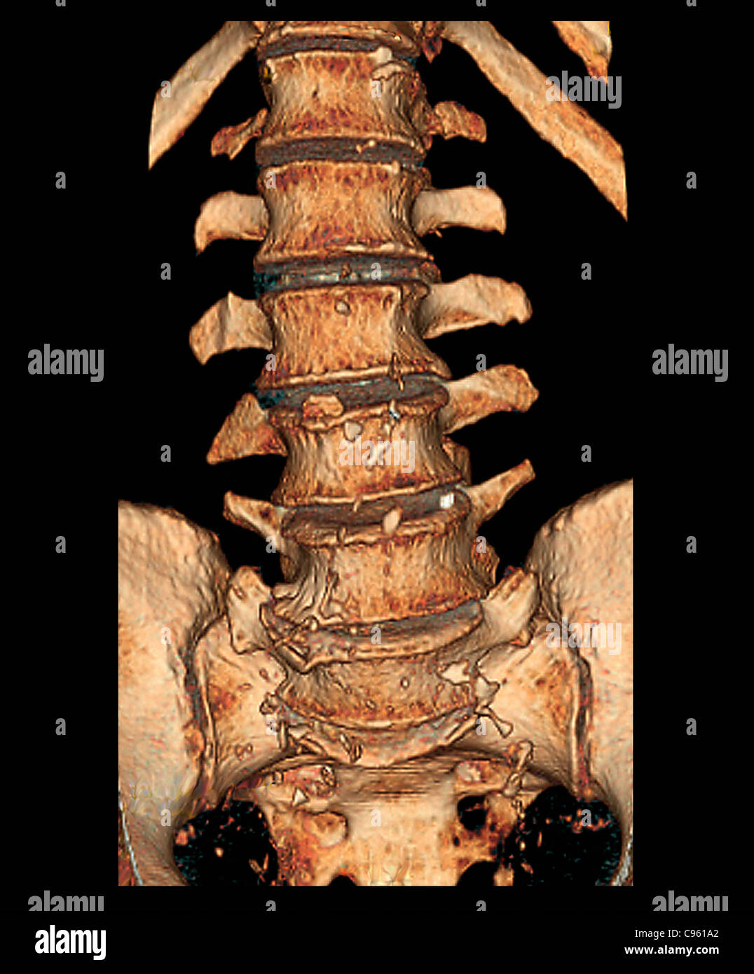 Degenerative Bandscheibenerkrankungen, 3D CT-scan Stockfoto